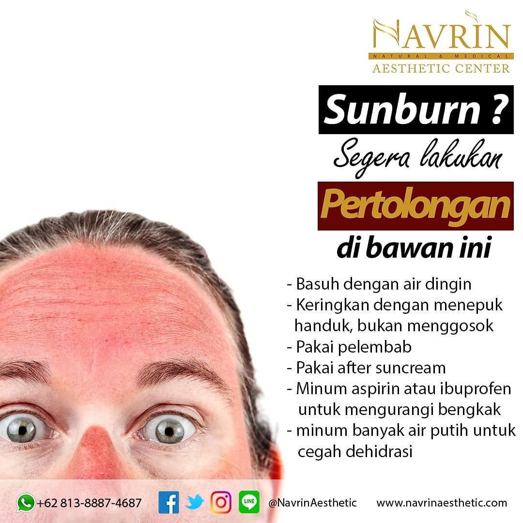 Mengatasi Sunburn Pada Wajah