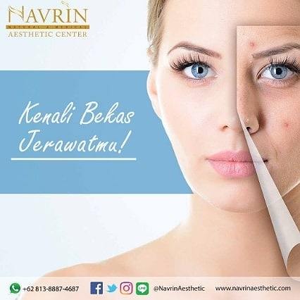 Jenis Bekas Jerawat Dan Cara Menghilangkannya