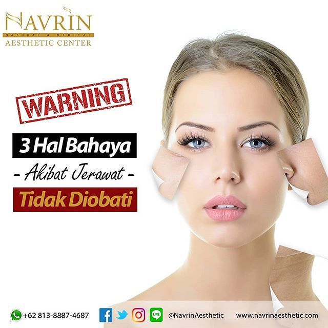 Bahaya Jerawat Jika Tidak Diobati