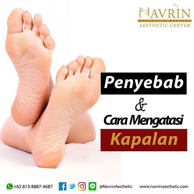 Cara Mengatasi Kaki Kapalan