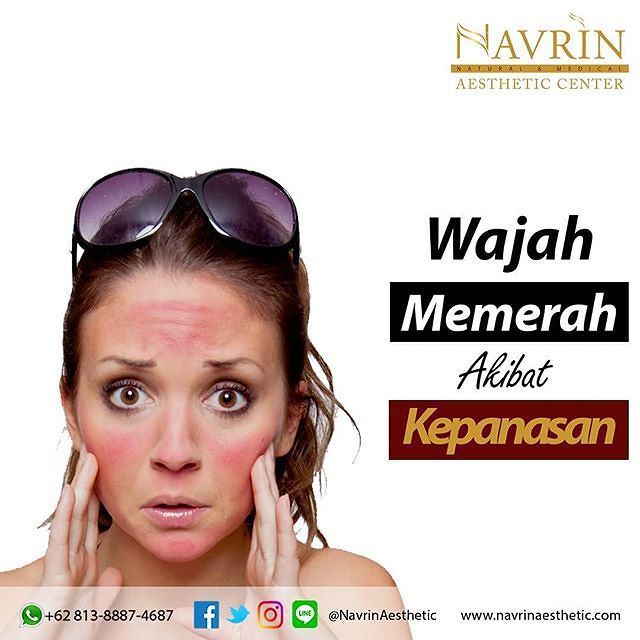 Wajah Merah Akibat Kepanasan