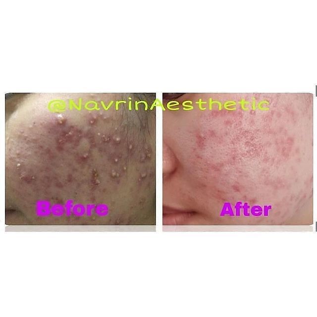 Testimoni Pemakaian Krim Jerawat Navrinaesthetic