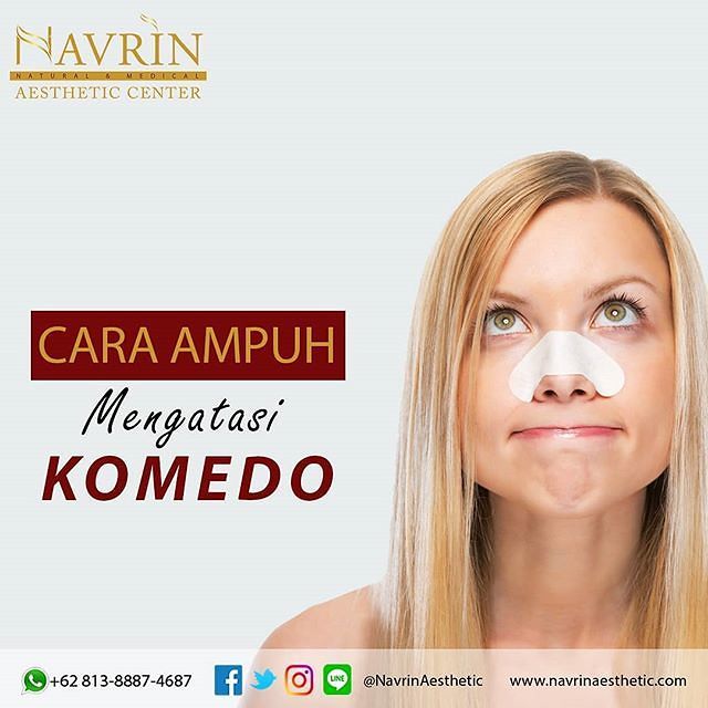 Cara Ampuh Mengatasi Komedo