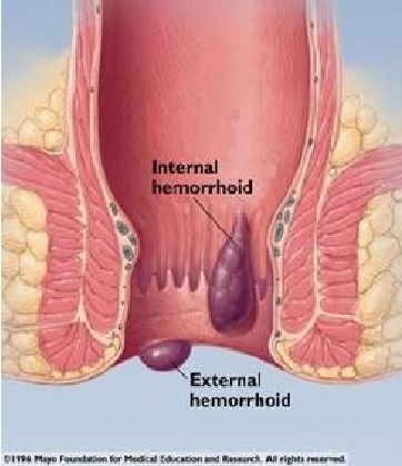Terapi Laser Pada Hemoroid