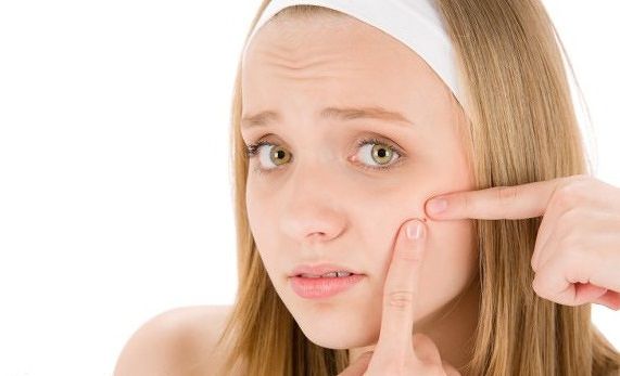Benarkah Tidur Terlalu Larut Bisa Memicu Jerawat? Simak Ulasannya