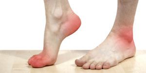 Kolesterol Tinggi Ternyata Bisa Menyebabkan Gejala Kesehatan Pada Kaki, Simak Ulasannya