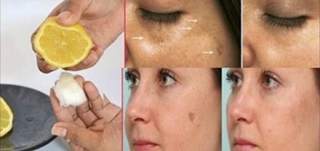 Cara Menghilangkan Flek Hitam