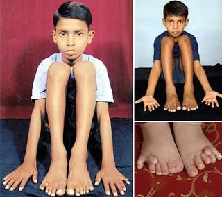 10 Manusia Dengan Tubuh Istimewa dan Langka