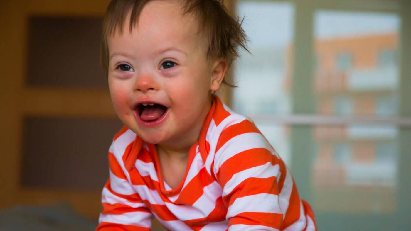 Apa Itu Down Syndrome 